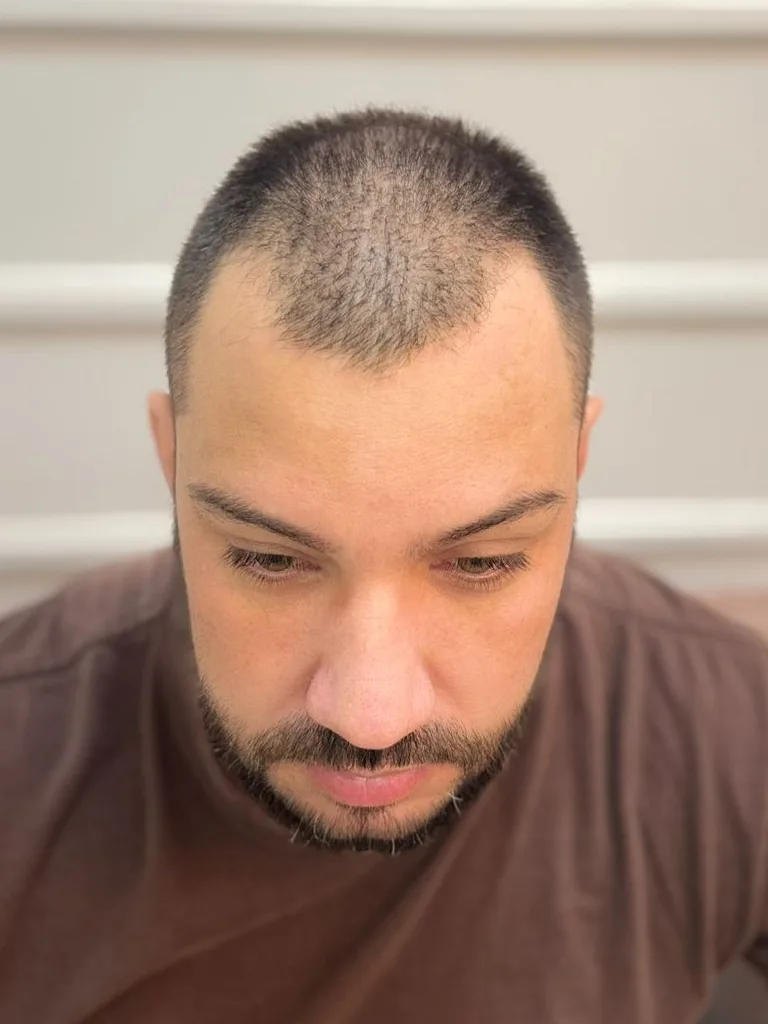 Paciente 5 antes do transplante