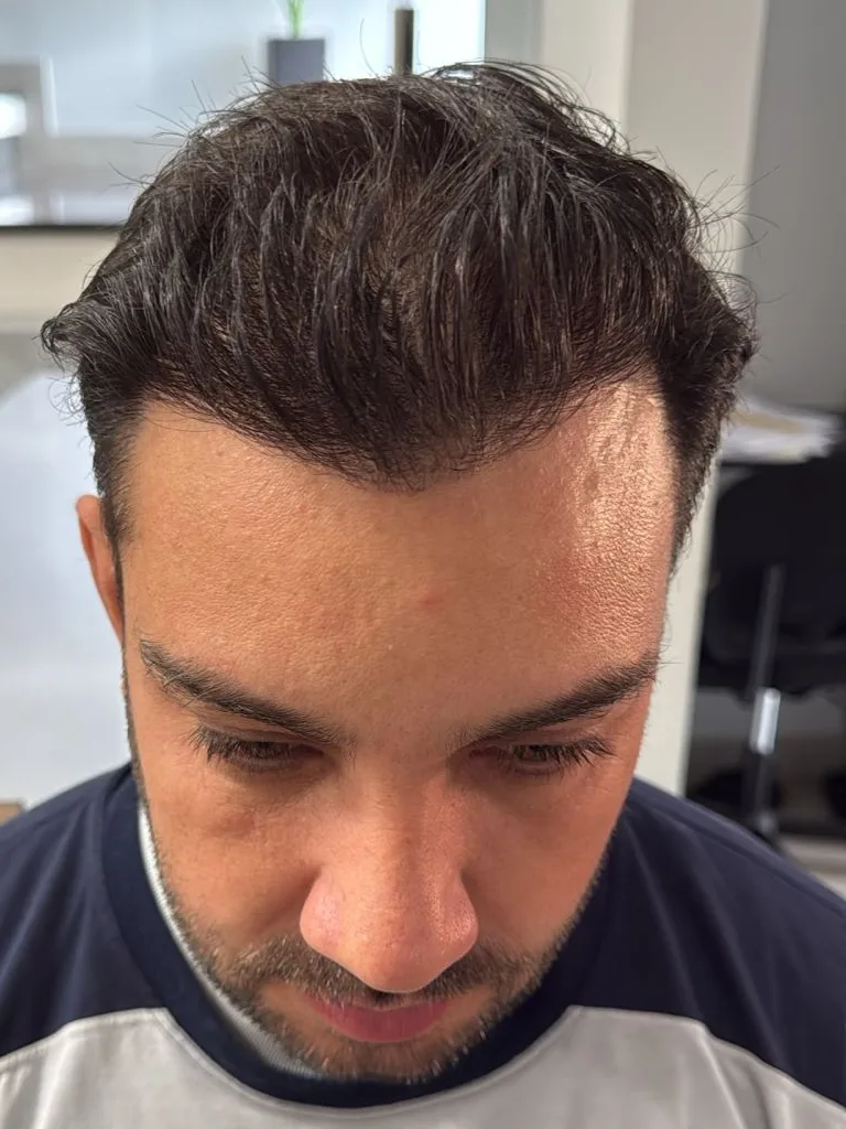 Paciente 5 depois do transplante