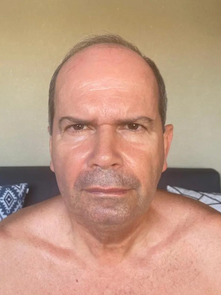 Paciente 4 antes do transplante