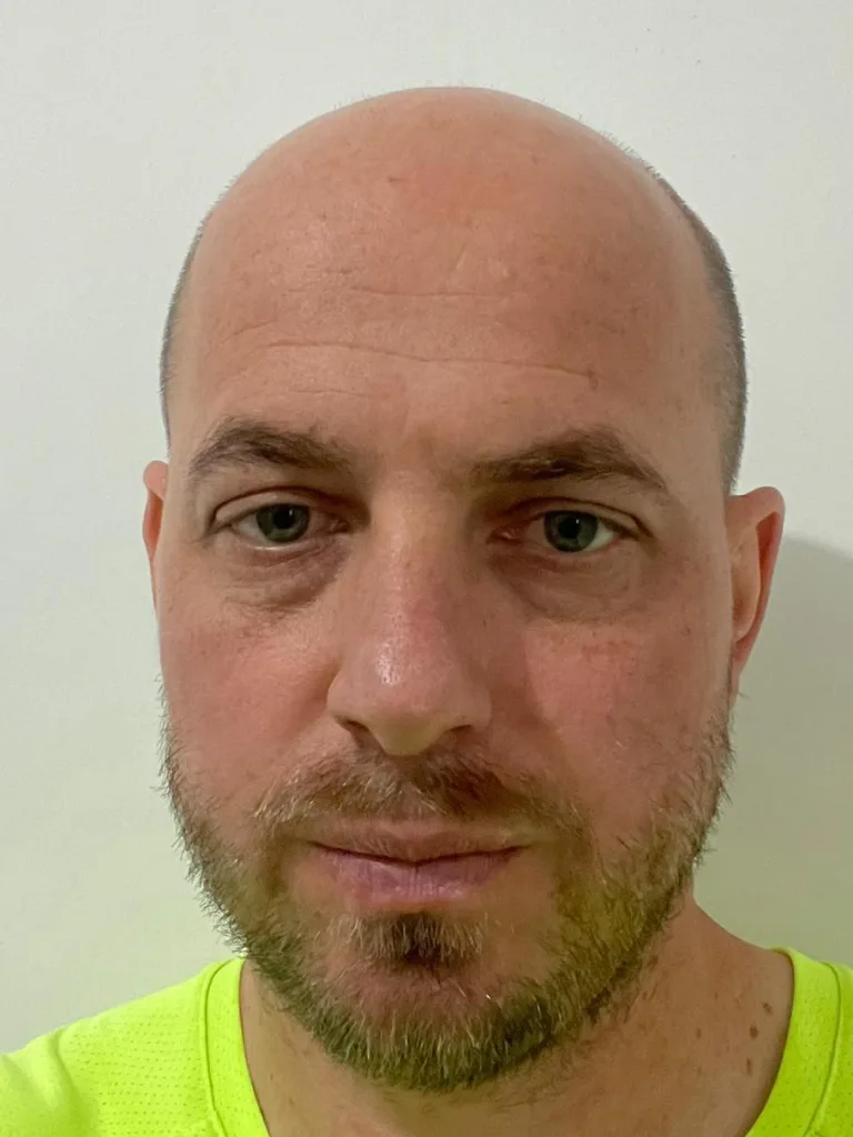 Paciente 3 antes do transplante