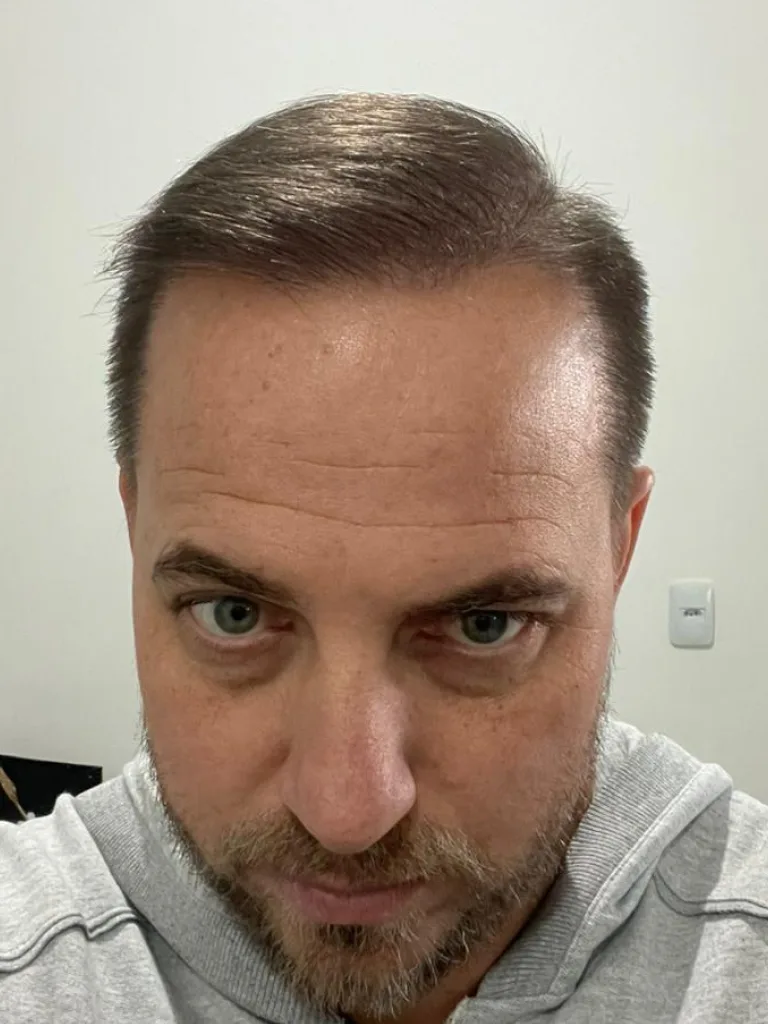 Paciente 3 depois do transplante