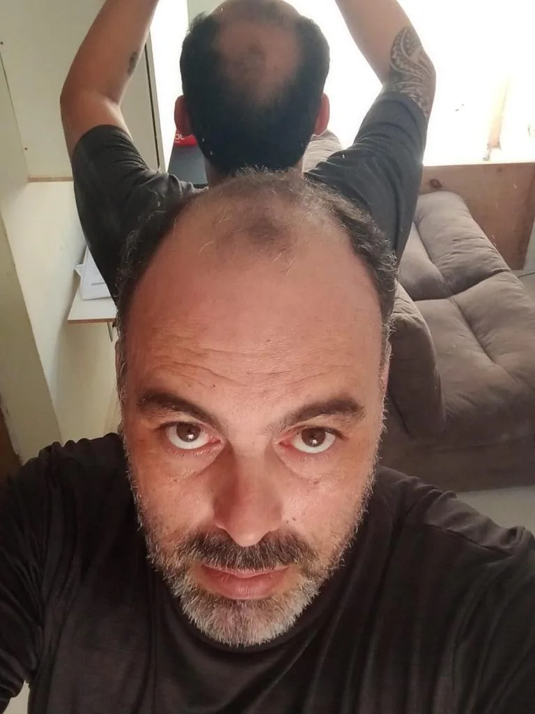 Paciente 2 antes do transplante