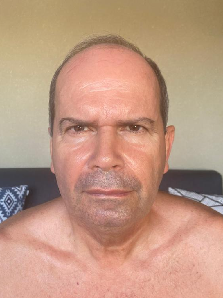 paciente-2-antes